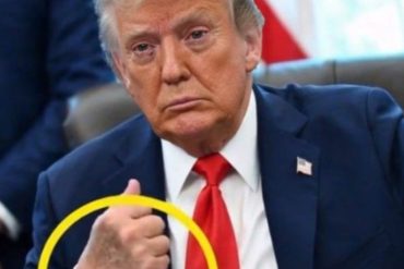 Donald Trump shows signs of chronic venous insufficiency with visible hand swelling during official appearance