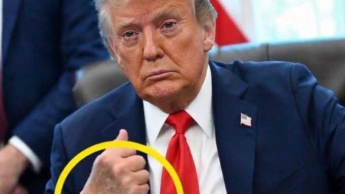 Donald Trump shows signs of chronic venous insufficiency with visible hand swelling during official appearance